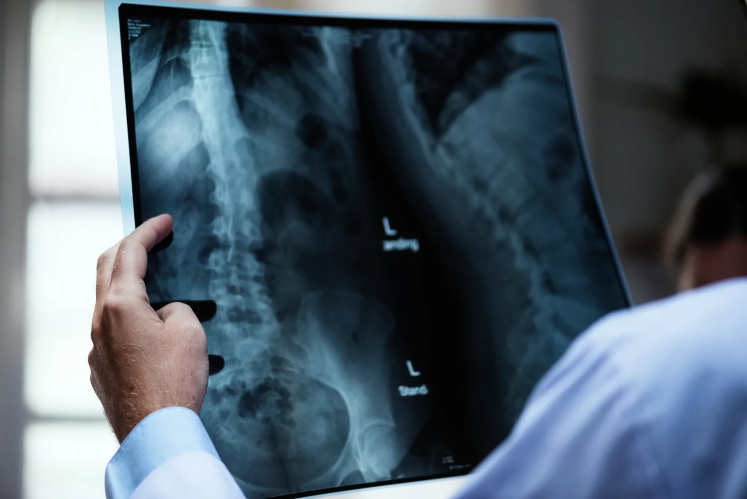 Fractura Vertebral en Mexicali, B.C.: Diagnóstico y tratamiento especializado